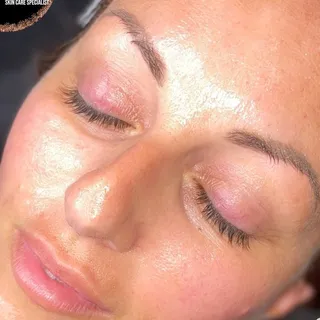 Glowing result of a Deluxe Hydrofacial