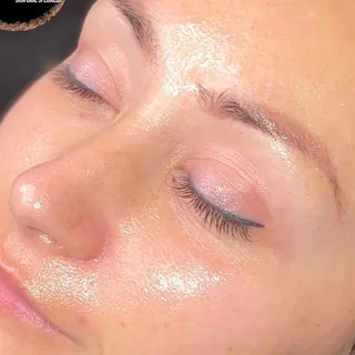 Fresh skin after an Ultimate Hydrofacial